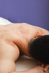 Man with acupuncture needles in his back is receiving treatment in a traditional Chinese medicine clinic. Needles close-up on a blue background - obrazy, fototapety, plakaty