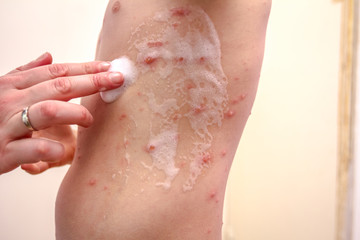 Therapy against the virus of Varicella has measles, chicken pox, rubella