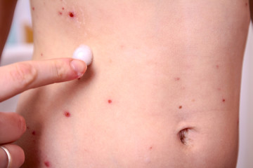 Fototapeta premium Therapy against the virus of Varicella has measles, chicken pox, rubella
