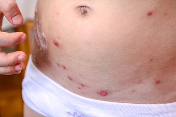Therapy against the virus of Varicella has measles, chicken pox, rubella