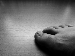Toenail fungus, onychomycosis, black and white.