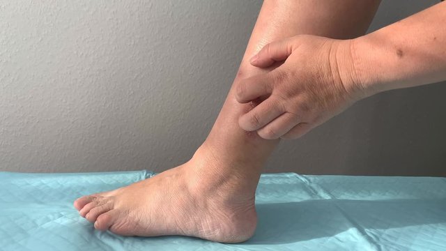 woman scratches an itchy wound on her leg, wound treatment. 4k, slow-motion shooting