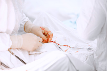 Doctor surgeon removes worm parasites from patient liver on operating table