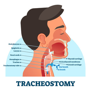 Tracheostomy cross section diagram, vector illustration