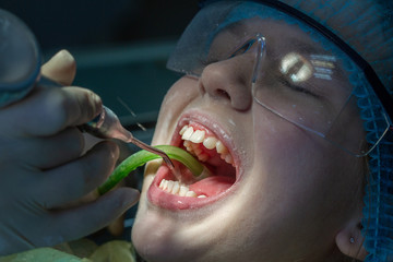 A child at the dentist's appointment. Dental treatment and brushing in the doctor’s office.