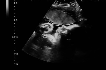 Face profile of the baby fetus in 35 weeks of pregnancy, ultrasound image of baby's head with his little hand