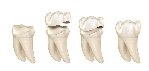 Porcelain crown placement over molar tooth. Medically accurate 3D illustration