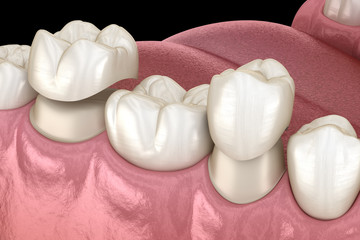 Fototapeta na wymiar Porcelain crowns placement over premolar and molar teeth. . Medically accurate 3D illustration