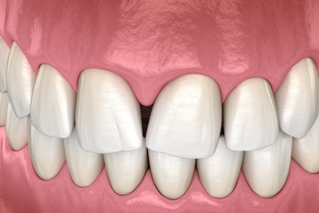 Convergent diastema of central incisors teeth. Dental disfunction 3D illustration concept