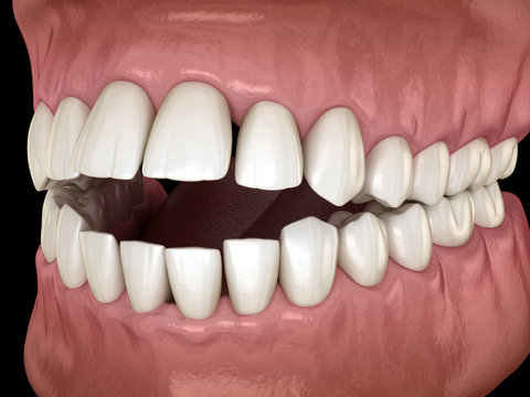 Openbite dental occlusion ( Malocclusion of teeth ). Medically accurate tooth 3D illustration