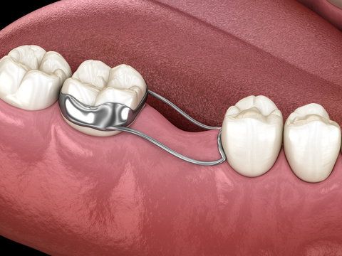 Space Maintainer Unilateral keeps from teeth shift deformatiuon after losing molar tooth. 3D illustration