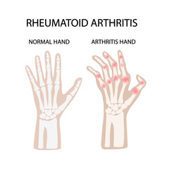 RHEUMATOID ARTHRITIS WHITE Chronic Disease Medicine Education Diagram Vector Scheme Human Hand Draw Vector Illustration