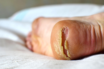 Dry cracked heel and callus on the foot. Monitor feet skin condition to prevent skin breakdown and trauma. Safefoot wear