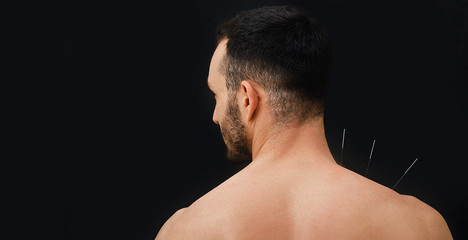 Close-up view from the back of a male patient with acupuncture needles in his shoulder on a black background. Acupuncture - obrazy, fototapety, plakaty