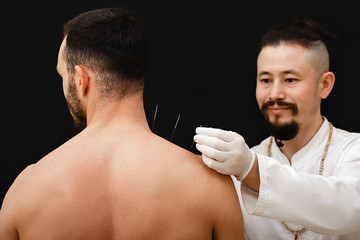 Reflexologist hand with acupuncture needle near the shoulder man. Treatment of a man’s body with...