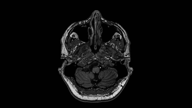 An MRI 3Tesla AX FLAIR scan of a person's braining from the front to the top. - close up shot. Cancer concept