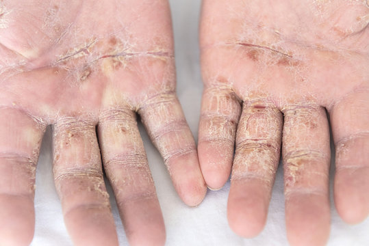 Hautkrankheit, Atiopischer Winterfu&szlig;, Fu&szlig;ekzem, Hautekzem, Dermatitis plantaris sicca, Ekzemkrankheiten, Atopisches Ekzem, Hautausschlag