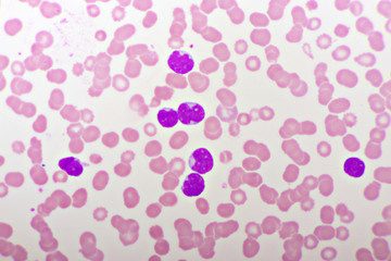 Picture of acute lymphocytic leukemia or ALL cells in blood smear, analyze by microscope, 1000x