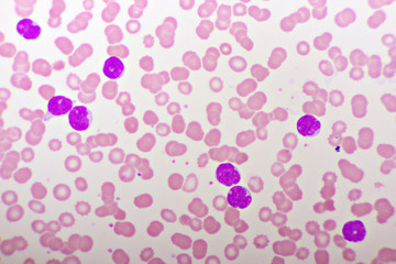 Picture of acute lymphocytic leukemia or ALL cells in blood smear, analyze by microscope, 1000x