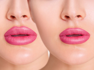 Beautiful female lips before anf after augmentation procedure.