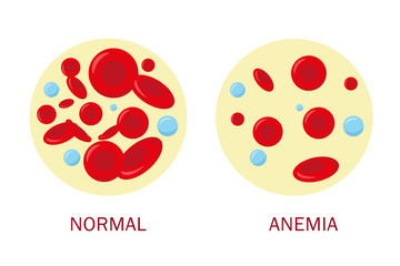 Nolmal blood cell and anemia blood cell. - obrazy, fototapety, plakaty