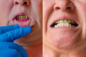 Periodontitis, an inflammatory process in the gums. Exposure of the necks of the teeth. The doctor...