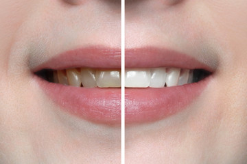 Stomatology, dental care and teeth whitening. Woman smile before and after. 