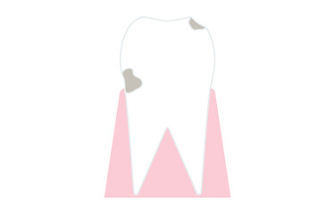 虫歯の進行、歯の表面が溶け出す