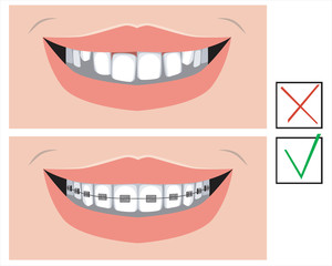 A smile with crooked teeth and with metal braces before and after the dental clinic, a vector stock illustration with molars as a concept for correcting occlusion and oral problems