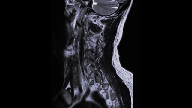MRI of cervical spine sagittal T2W view  for diagnostic Spinal Cord Compression at C3,C4.