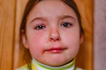 Sad girl child with hurt and scratches on the face from bump, insurance concept or pain concept.