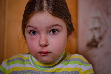 Sad girl child with hurt and scratches on the face from bump, insurance concept or pain concept.