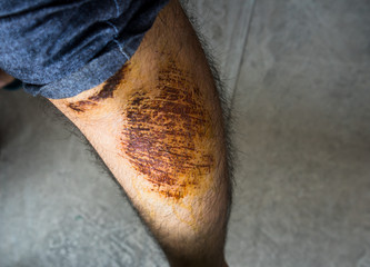 Man with large scab wound on his left leg