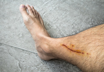 Man with long scab wound on his right leg
