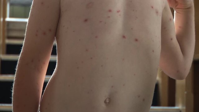 Young Boy with Chickenpox rash and spots on his chest. His dad rubs cream onto the blisters. Stock Video Clip Footage