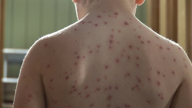 Young Boy with Chickenpox rash and spots on his back. His dad rubs cream onto the blisters. Stock Video Clip Footage
