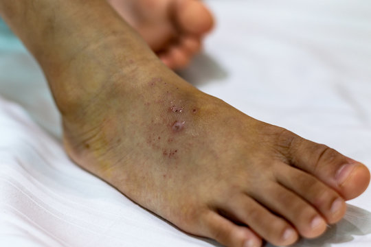 Hand Foot and Mouth Disease in Asian Children (HFMD).