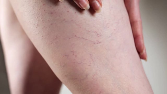 A Caucasian woman runs her hand over her legs with vascular asterisks. White background. Close up. The concept of varicose veins and treatment