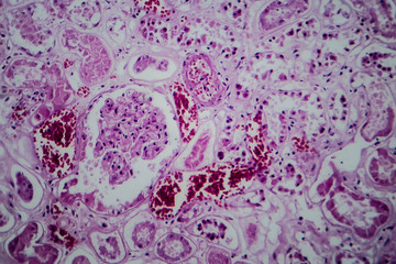 Acute glomerulonephritis, light micrograph