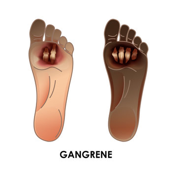 Diabetic Foot. Gangrene. Ulcers, skin sores on foot