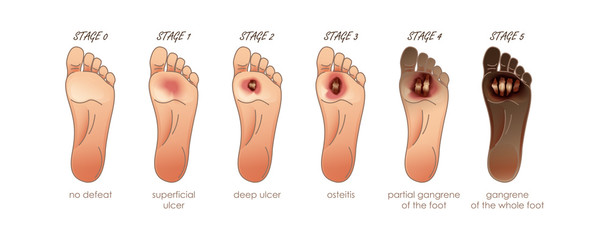 Diabetic Foot. Stages of defeat. Ulcers, skin sores on foot - obrazy, fototapety, plakaty