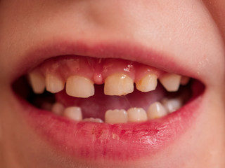 Naklejka premium Cute baby shows dropped baby tooth. Child smiles with toothless mouth. Lips and teeth close up