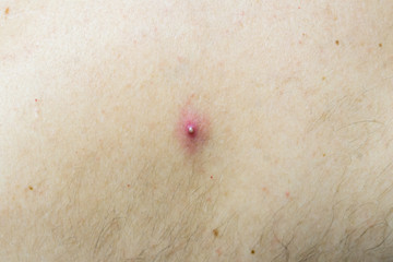 a pimple on the skin of a light-skinned man.