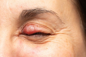 Swollen chalazion on the upper eyelid of a woman's eye, noticeable swelling and redness due to...