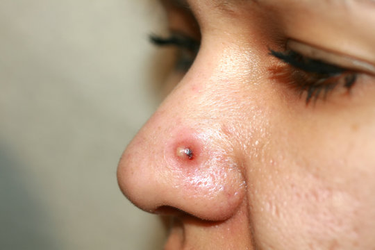Inflamed pimple on nose. Cyst Acne. Acne on the skin