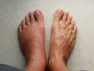 Obraz na płótnie Canvas Swollen leg after a wasp bite.