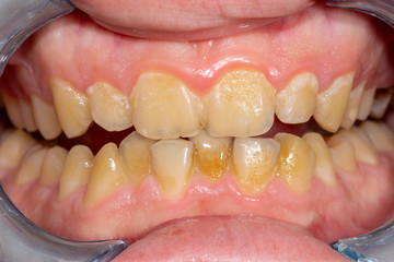 tartar close-up on the lower anterior incisors. Dental hygiene of teeth