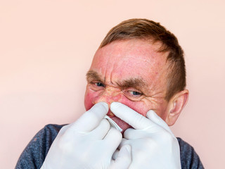 Demodecosis of the face. A man in gloves does the treatment of facial skin with medications. Prevention and treatment of skin diseases.