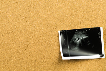 ultrasound pregnancy photo on cork board. Baby fetus photo as a first pregnancy sticky note 