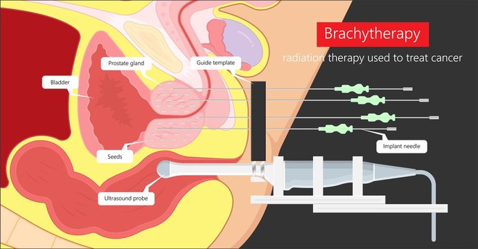 Brachytherapy procedure radioactive material medical treatment therapy